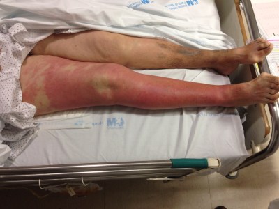 Infecciones de piel y partes blandas